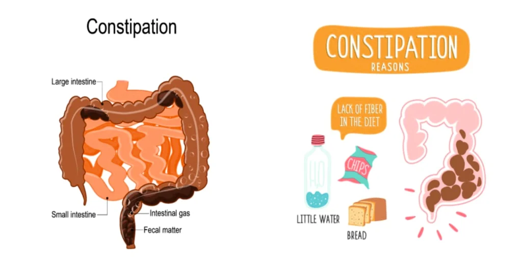 Causes of Constipation
